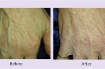 Woman age: 60;  Treated area: dorsal of the palm;  3 weeks following the 1st treatment