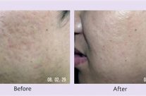 Man age: 31; Treated area: cheeks;  6 weeks following the 2nd treatment
