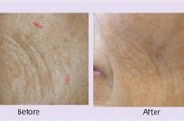 Woman age: 58; Treated area: left cheek (wrinkles);  1.5 months following the 1st treatment