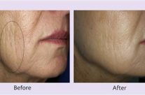 Woman age 57; Treated area: right cheek;  8 months following 3rd treatment