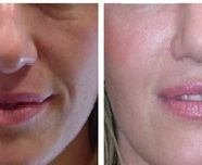 Anti-aging, skin, scar, volume corrections prp and fat treatments