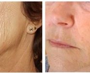 Anti-aging, skin, scar, volume corrections prp and fat treatments